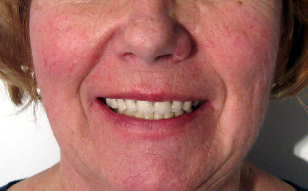 ferencne-sourire-apres