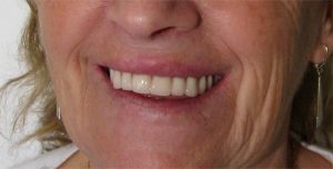 appareil-amovible-prothese-dentaire-amovible