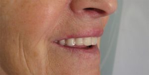 appareil-amovible-prothese-dentaire-amovible-D