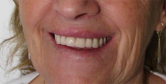 appareil-amovible-prothese-dentaire-amovible