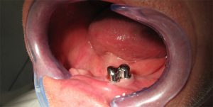 couronnes-telescopiques