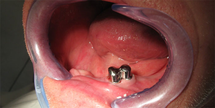 couronnes-telescopiques