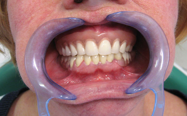 ferencne-dents-apres