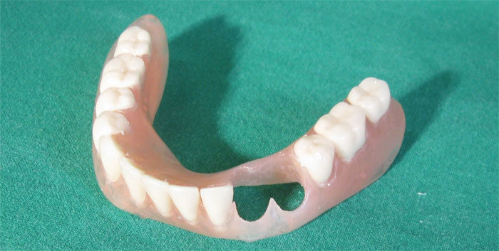 prothese-provisoire-amovible