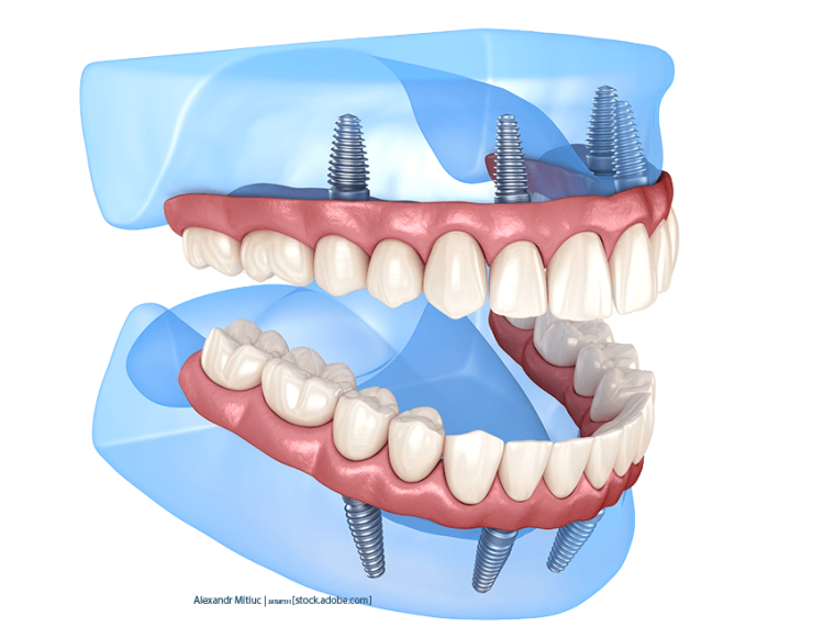 All-on-4-Methode-AdobeStock_297287511.png-compressed-2c1a0f41